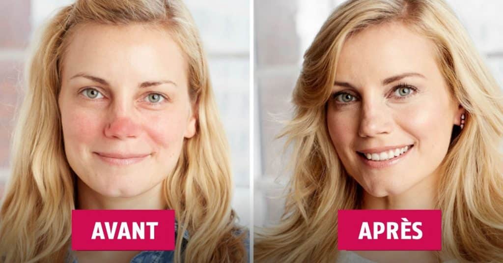 Nez rouge que faire : quelle solution contre le froid ?